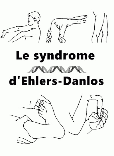 Ehlers Danlos